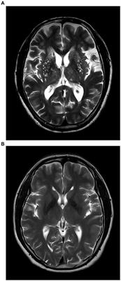 Higher critical closing pressure is independently associated with enlarged basal ganglia perivascular spaces